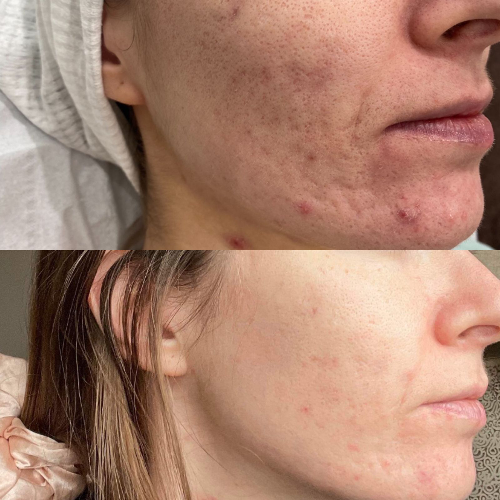 Acne Scarring